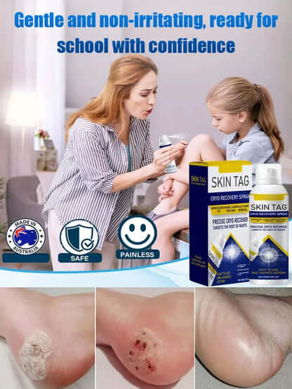 Wart Care Topical Spray