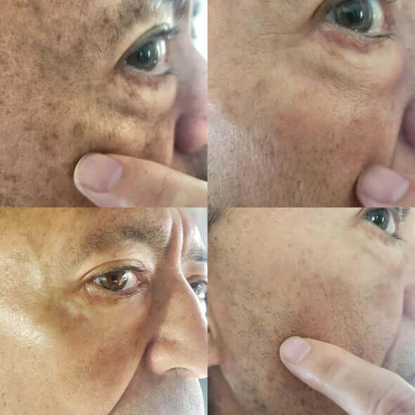 ✨Fast Dark Spot Remover-Natravor®  Melanin Correcting Facial Serum(🔥Last Day Promotion 60% OFF)