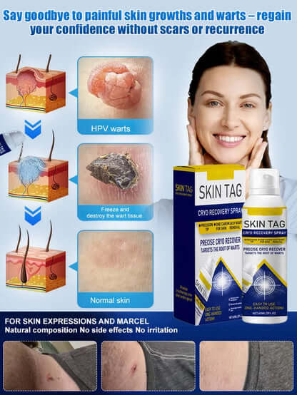 Wart Care Topical Spray