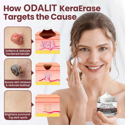 ✅Flash Sale - ODALIT®KeraErase Dual-Action Renewal Cream