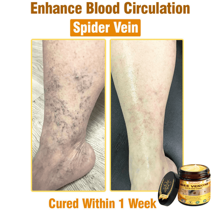 Natravor®𝐁𝐞𝐞 𝐕𝐞𝐧𝐨𝐦 𝐀𝐥𝐥-𝐢𝐧-𝐎𝐧𝐞 𝐂𝐫𝐞𝐚𝐦–🌸 Anti-aging,Hydrating, Skin Repair, Even Tone, Acne and Dark Spot Treatment, Wart and Mole Removal, Psoriasis Relief