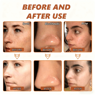 Whitening and Spot-Removing Face Mask Suitable for face and body – 👩‍⚕️ Natural ingredients permanently remove age spots, freckles, sun spots, and liver spots.